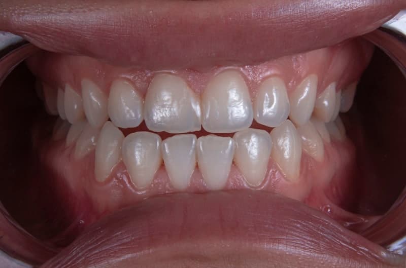 Facial Rejuvenation
